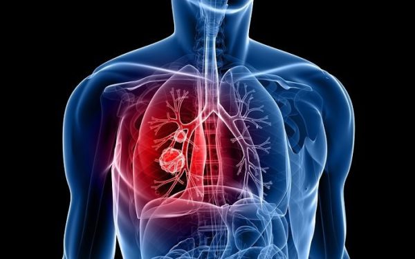 Objawy Raka Płuc Fundacja Onkologiczna Alivia 7770